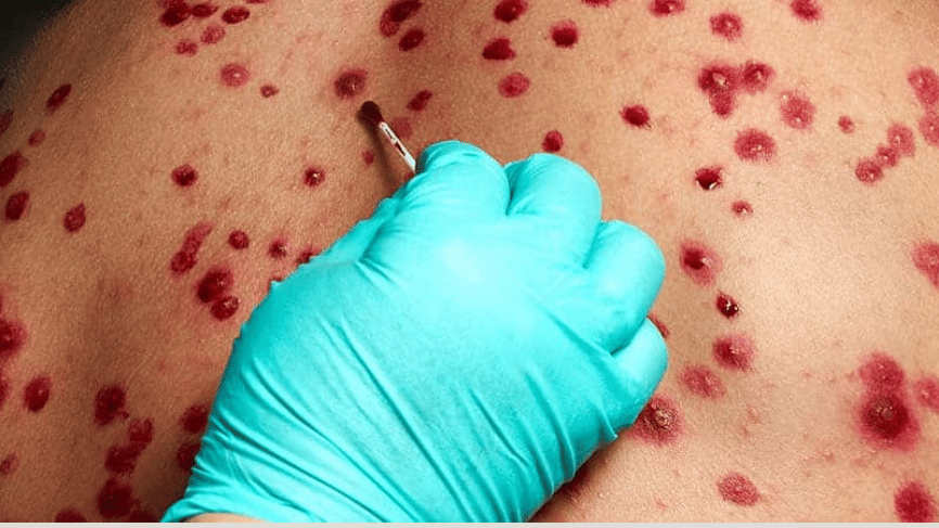 Lima registra 58 casos de viruela de mono en 2024: los distritos con más incidencia de MPOX