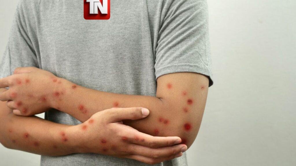 Ecuador en alerta: detectan primer caso de Mpox Clado Ib y refuerzan medidas ante riesgo de propagación