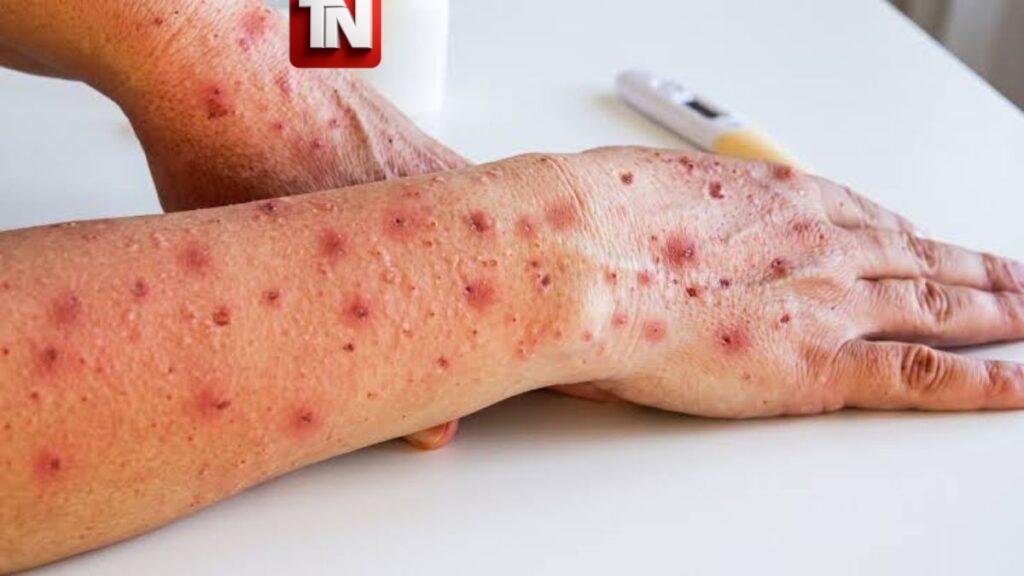 Confirman dos casos de viruela símica en San Cristóbal; Salud Pública activa vigilancia epidemiológica